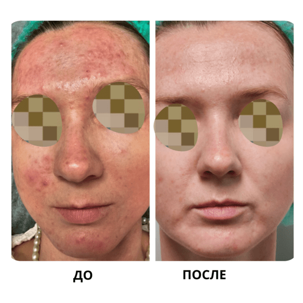 До и после: Постакне, рубцы