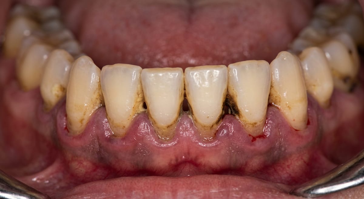 До: Пародонтит тяжёлой степени