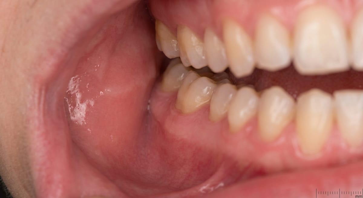 После: Афтозный стоматит