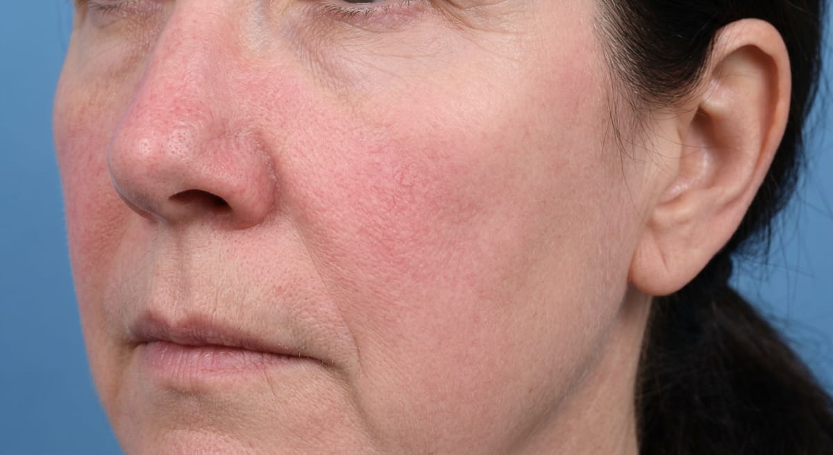 После: Розацея, эритематозная форма