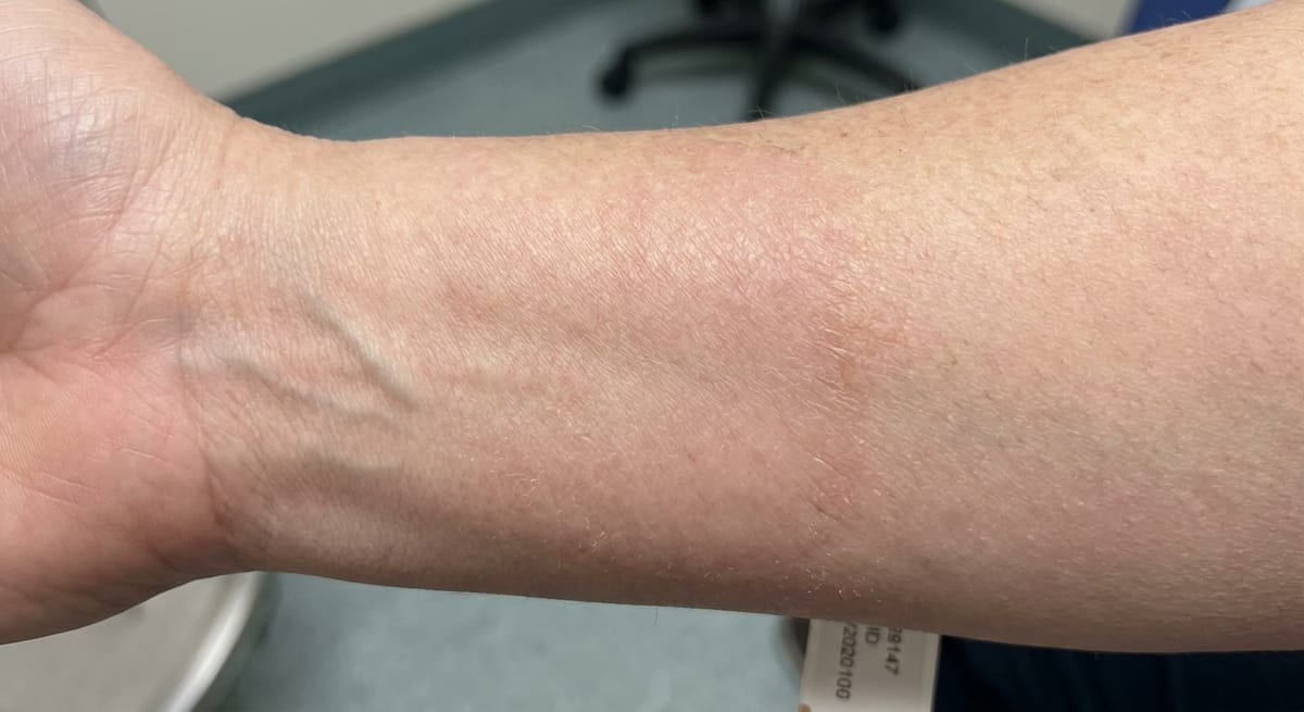 После: Псориаз, ограниченная форма