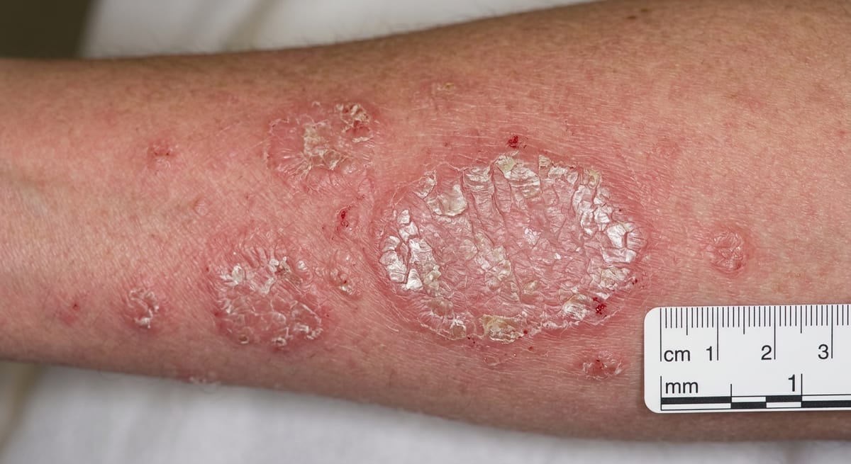 До: Псориаз, ограниченная форма