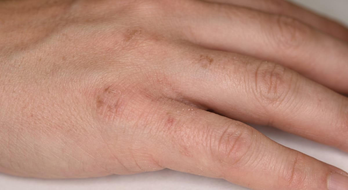 После: Кондиломатоз вульвы