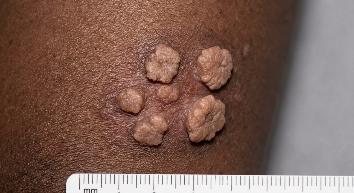 До: Кондиломатоз вульвы