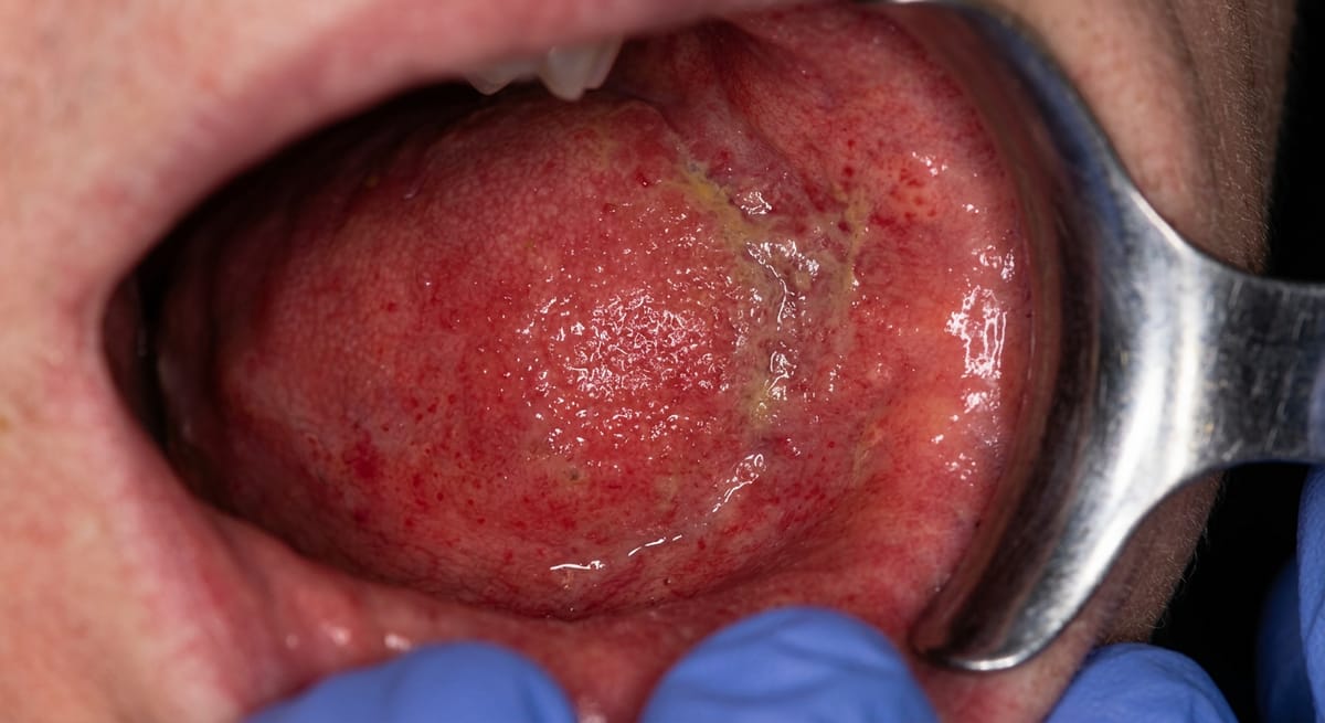 До: Хронический цервицит