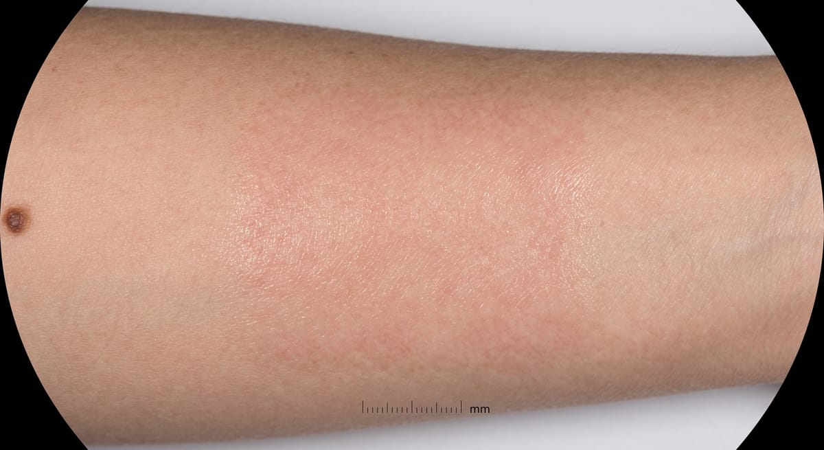 После: Крауроз вульвы