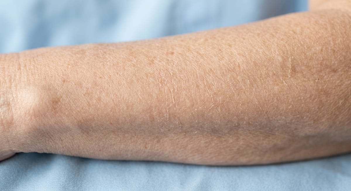 До: Крауроз вульвы