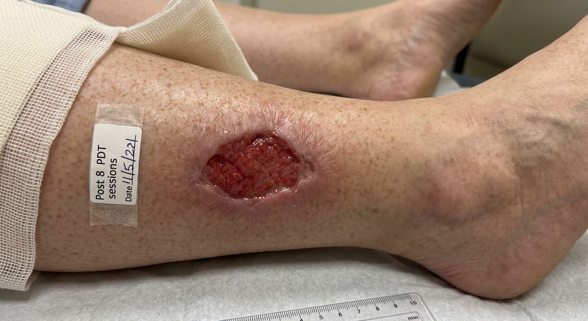 После: Трофическая язва нижних конечностей