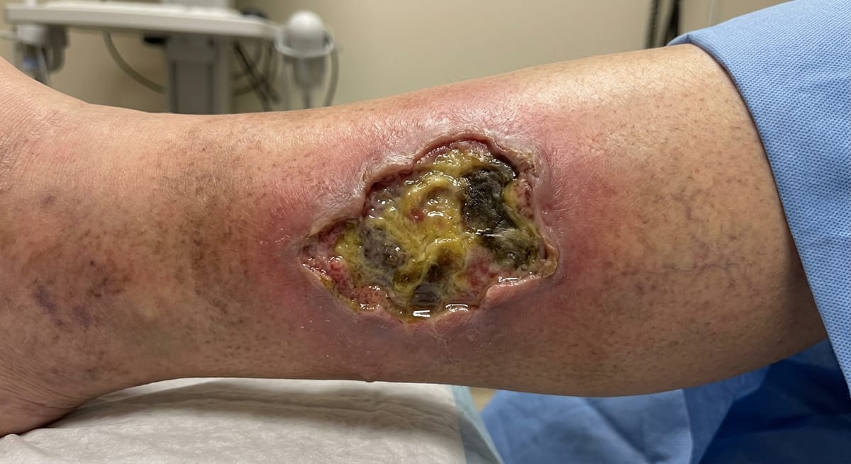 До: Трофическая язва нижних конечностей