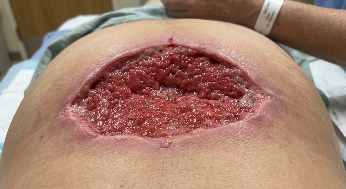 После: Пролежень II–III степени