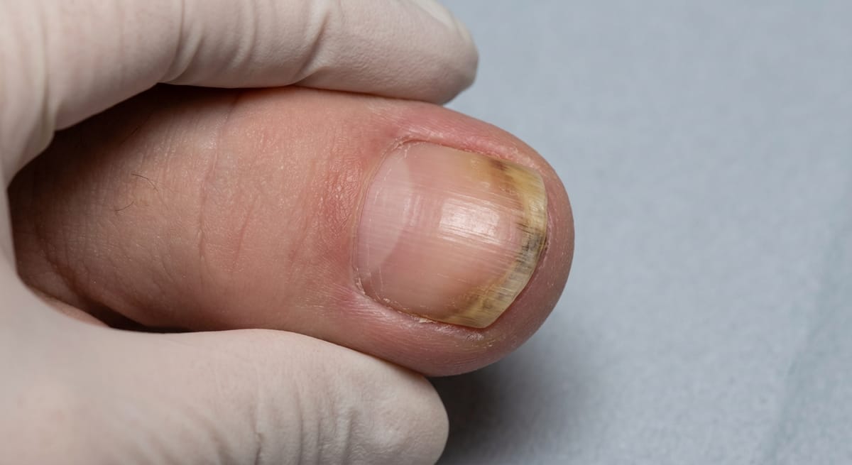 После: Онихомикоз (грибок ногтей)