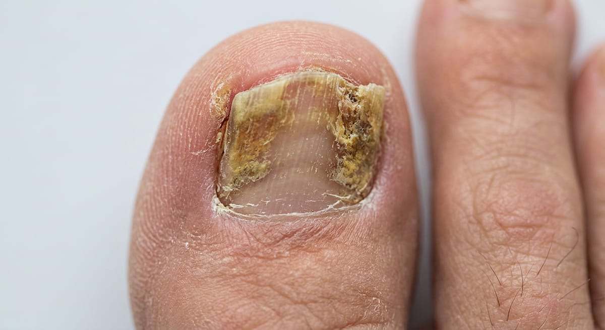 До: Онихомикоз (грибок ногтей)