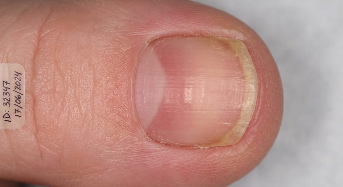 После: Ониходистрофия