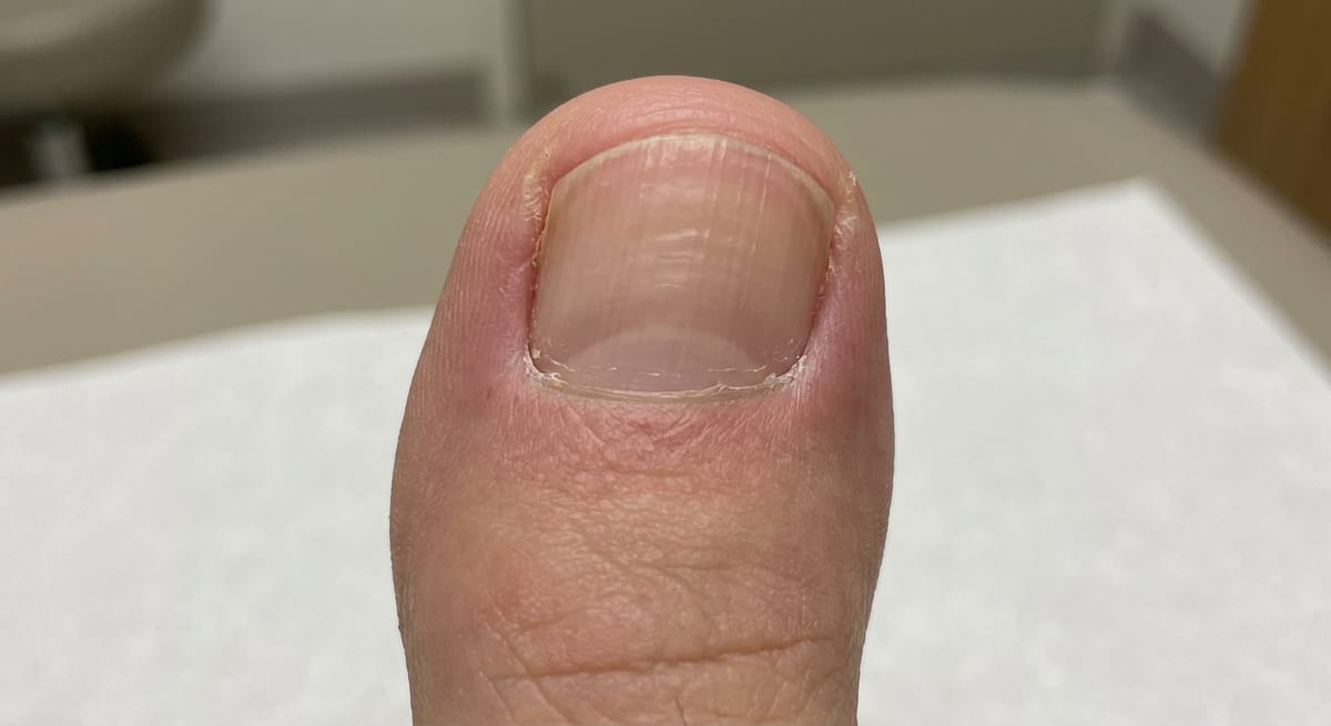 После: Вросший ноготь (постоперационно)