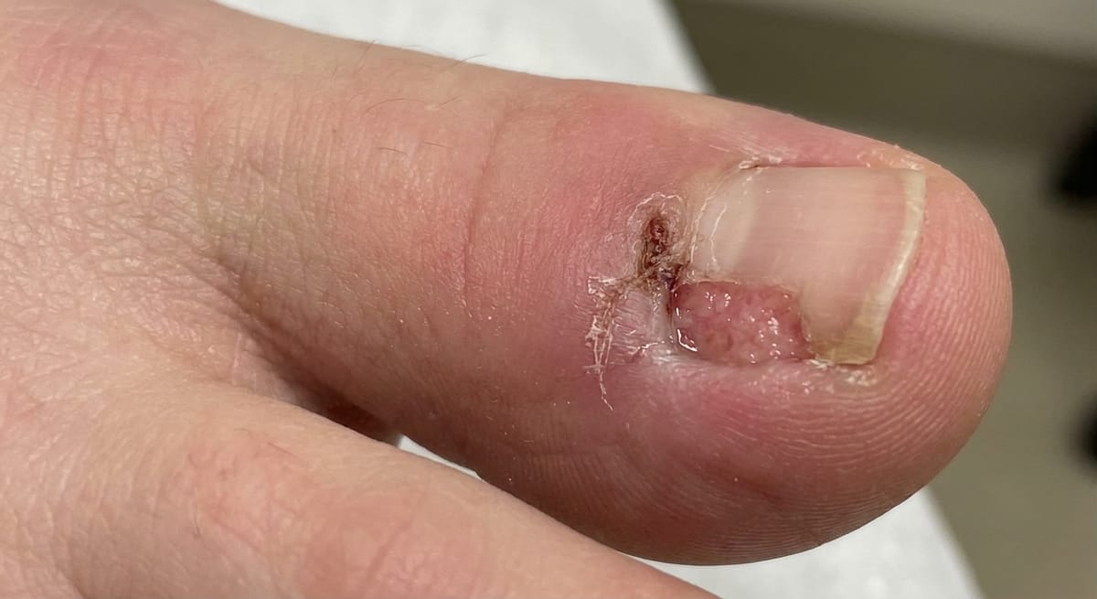 До: Вросший ноготь (постоперационно)