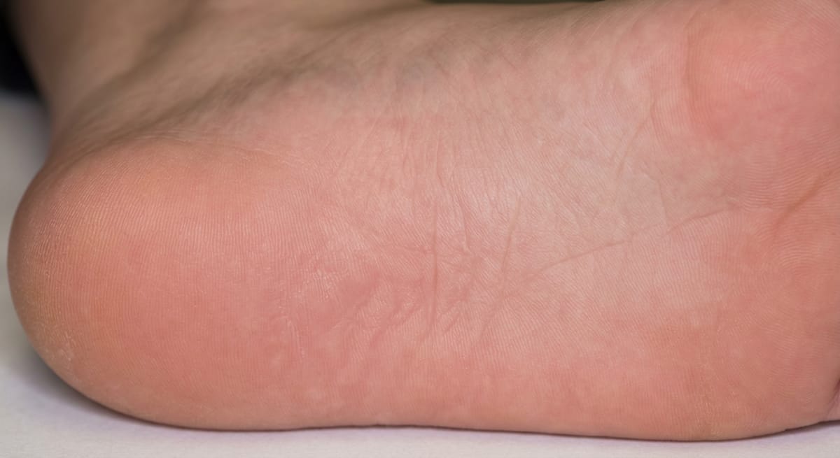 После: Подошвенные бородавки (verruca plantaris)