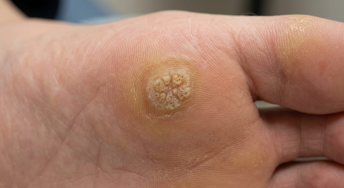 До: Подошвенные бородавки (verruca plantaris)