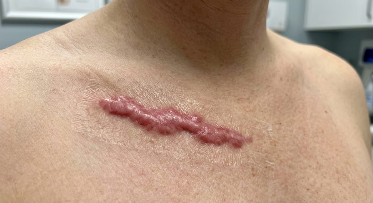 До: Послеоперационный рубец