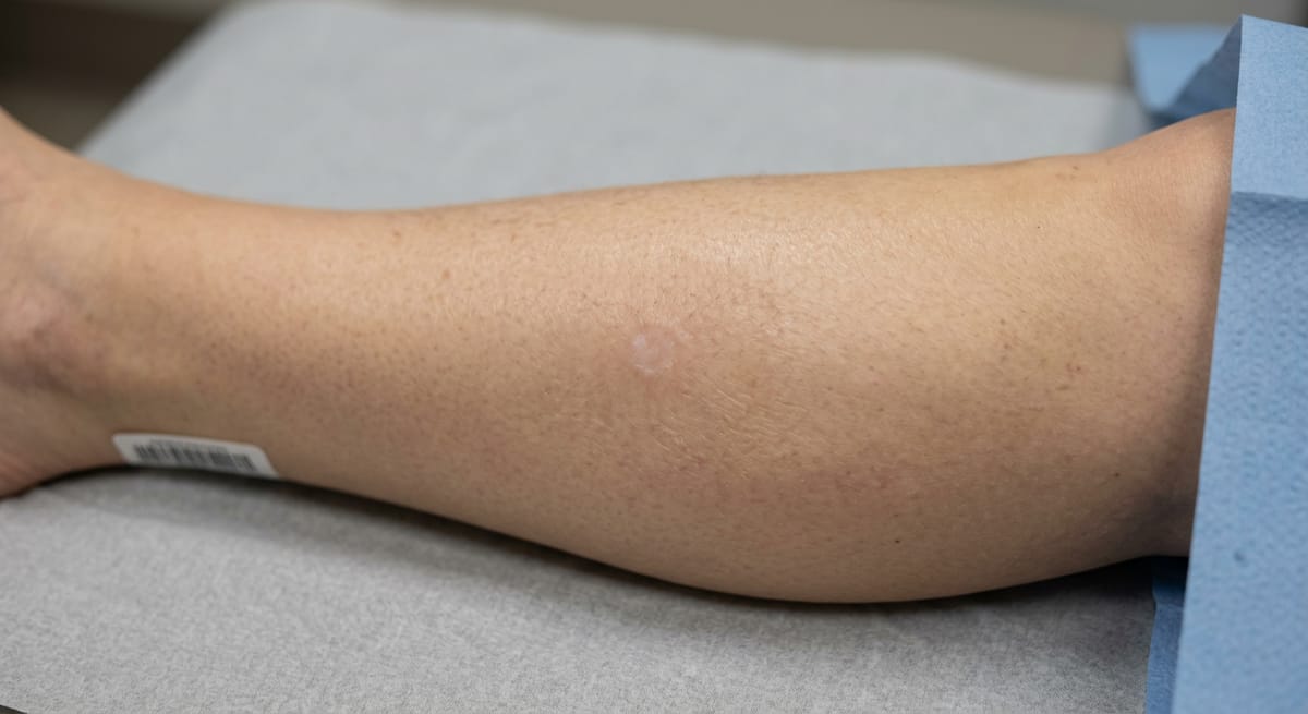 После: Трофическая язва голени