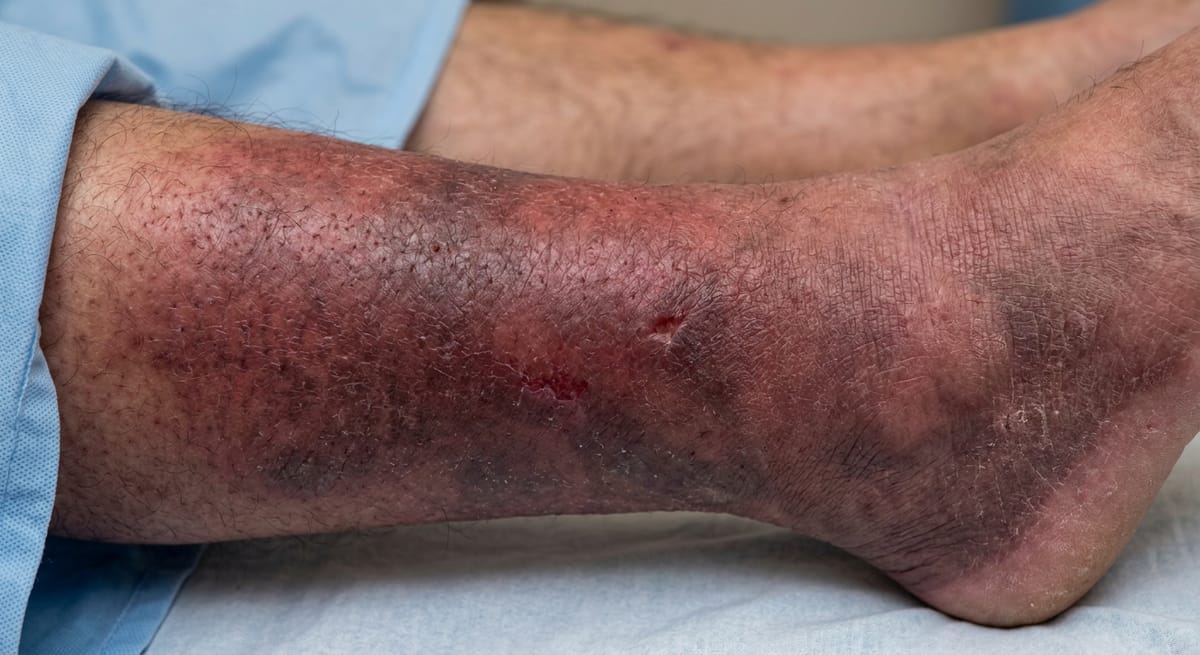 До: Трофическая язва голени