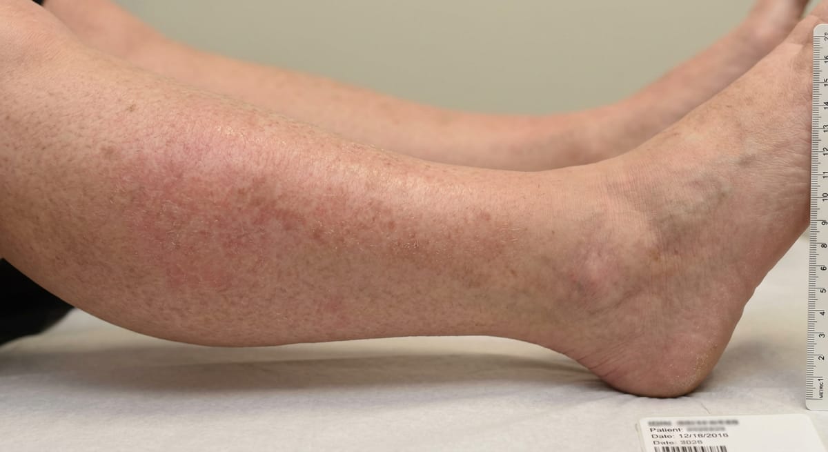 После: Рожистое воспаление