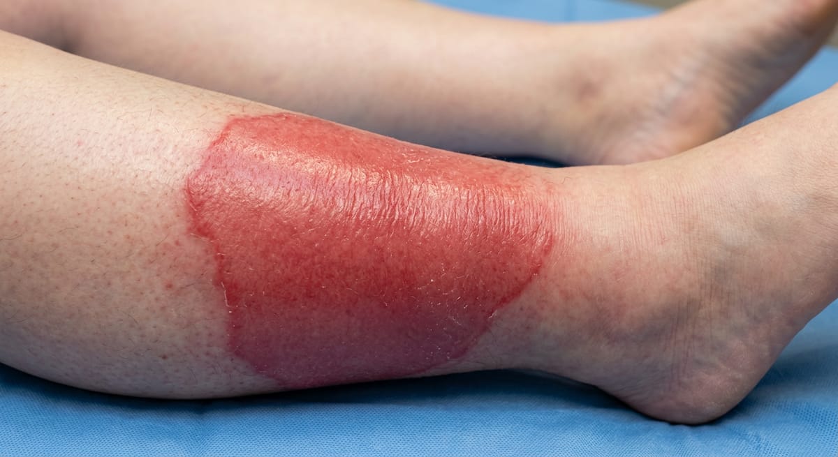 До: Рожистое воспаление