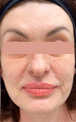 После курса ФДТ с CHLODERM®