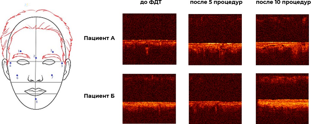 ОКТ изображения кожи лица до и после ФДТ с CHLODERM®