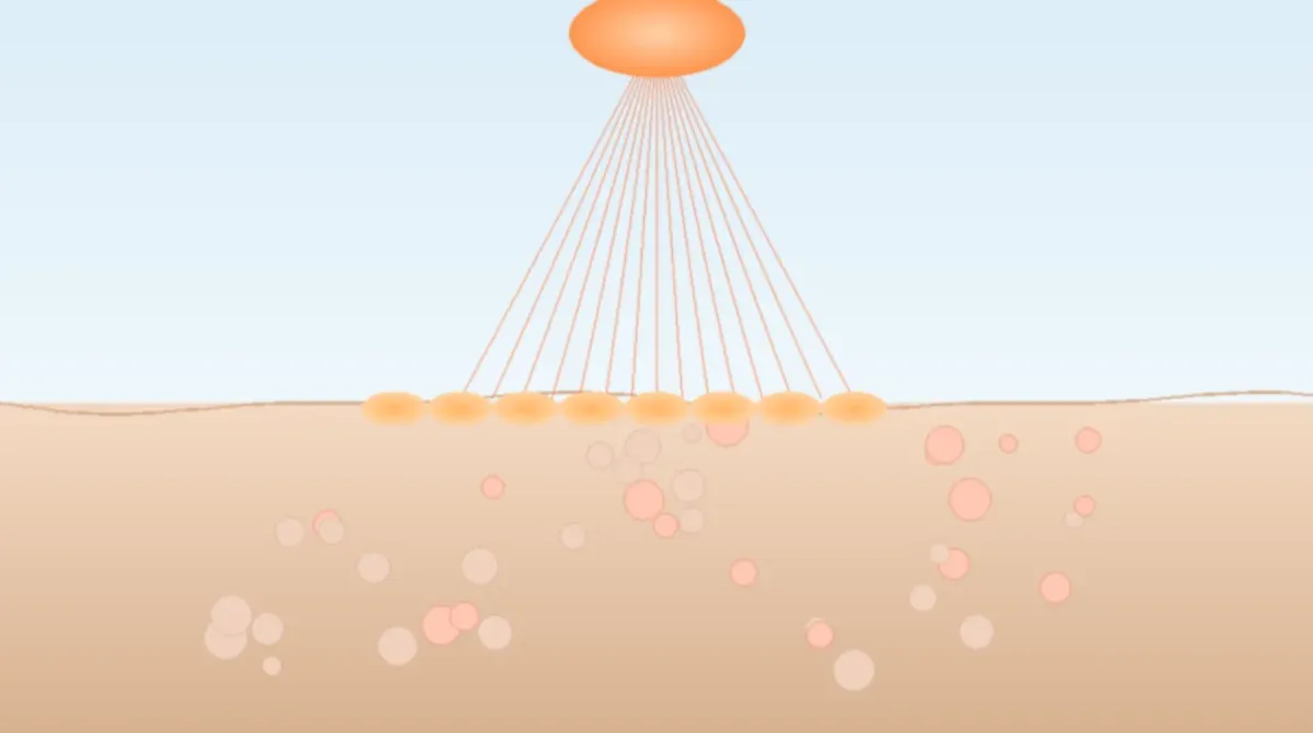 ФДТ при актиническом кератозе и полевой канцеризации: европейский консенсус 2025