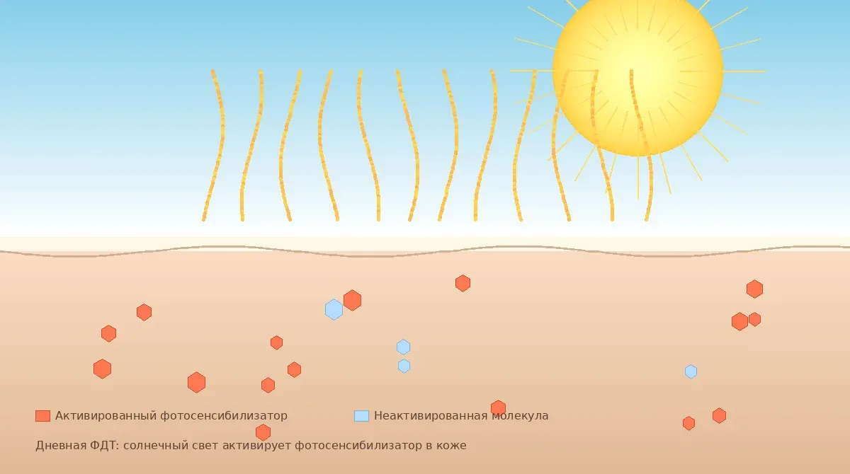 Дневная ФДТ — солнечный свет активирует фотосенсибилизатор в коже при лечении актинического кератоза